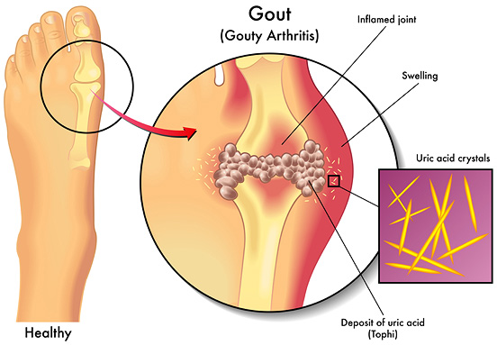 Homeopathic Medicine for Relief from the Pain of Gout