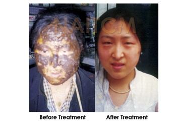 Important Breakthrough for Facial Burn Treatment
