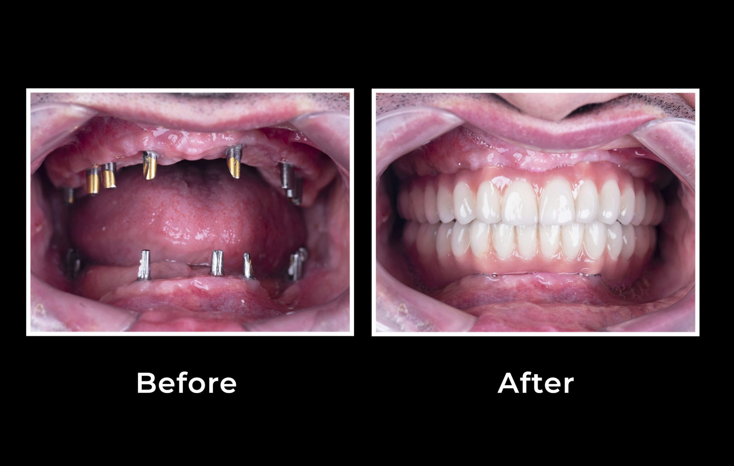 Low Cost Dental Implants Vitality Magazine   Dentalimplants Web Scaled 2400x1524 C 